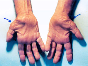 Untreated Carpal Tunnel Syndrome