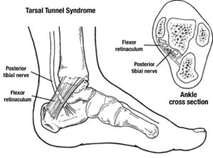 Tarsal Tunnel Syndrome Test - California