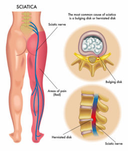 Sciatic Neuropathy Test in California