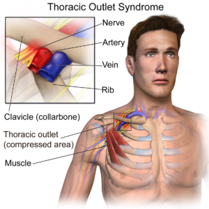 Neurogenic Thoracic Outlet Syndrome Testing, Southern California
